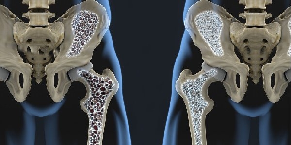 La Giornata mondiale dell’osteoporosi celebrata nella Casa della salute