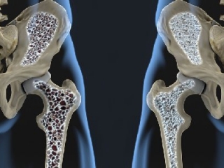 La Giornata mondiale dell’osteoporosi celebrata nella Casa della salute